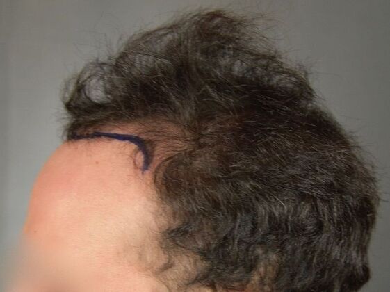 FUT Hair Restoration: Case 32 - Before