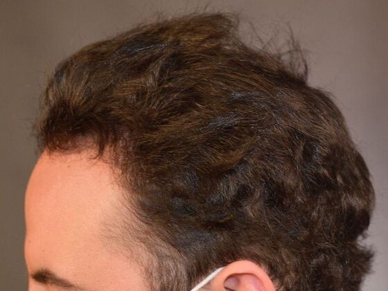 FUT Hair Restoration: Case 32 - After