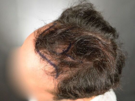 FUT Hair Restoration: Case 32 - Before