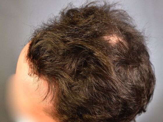 FUT Hair Restoration: Case 32 - After