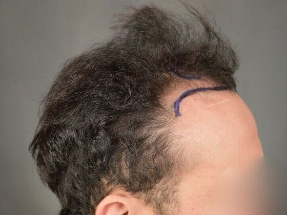 FUT Hair Restoration: Case 32 - Before