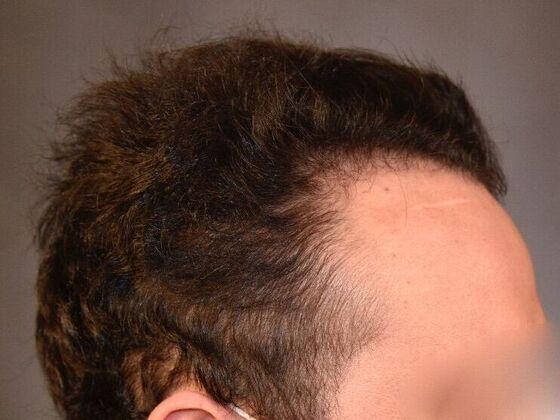 FUT Hair Restoration: Case 32 - After