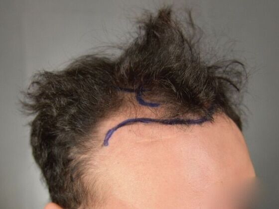 FUT Hair Restoration: Case 32 - Before