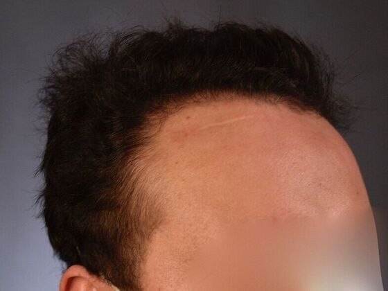 FUT Hair Restoration: Case 32 - After