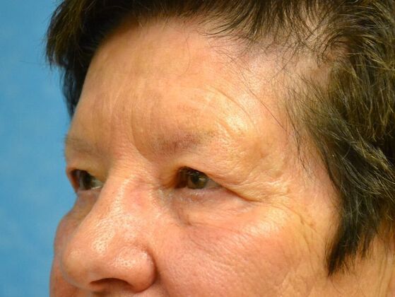 Eye Lift (Blepharoplasty): Case 1774- Bowling Green, OH - Before