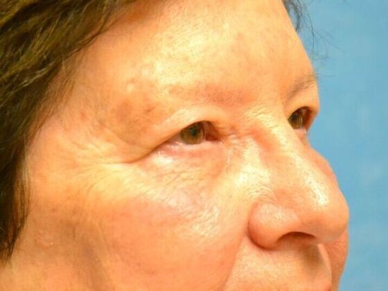 Eye Lift (Blepharoplasty): Case 1774- Bowling Green, OH - Before