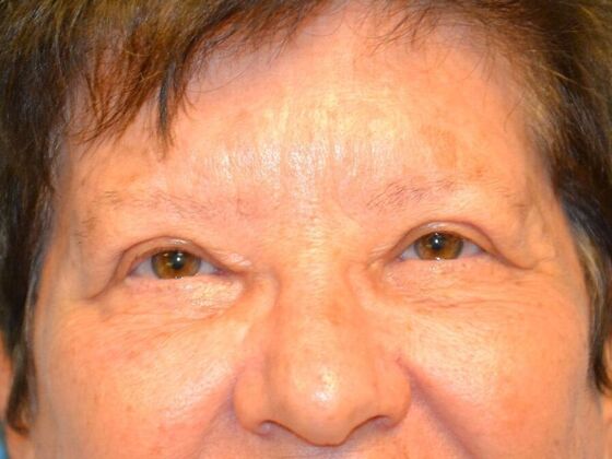 Eye Lift (Blepharoplasty) Case 1774- Bowling Green, OH - After