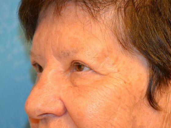 Eye Lift (Blepharoplasty): Case 1774- Bowling Green, OH - After