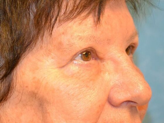 Eye Lift (Blepharoplasty): Case 1774- Bowling Green, OH - After