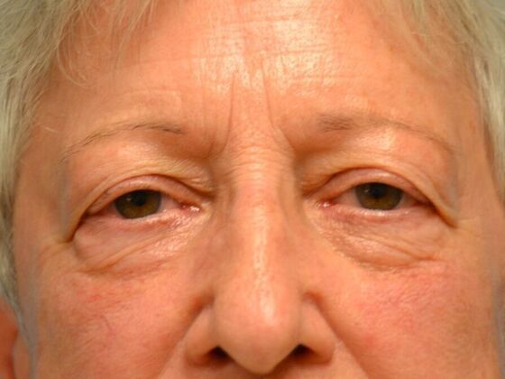 Eye Lift (Blepharoplasty) Case 1773- Temperance, MI - Before