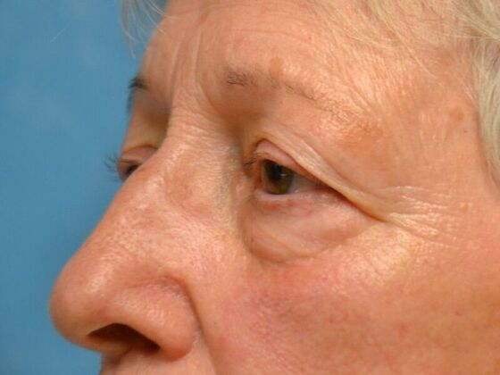 Eye Lift (Blepharoplasty): Case 1773- Temperance, MI - Before