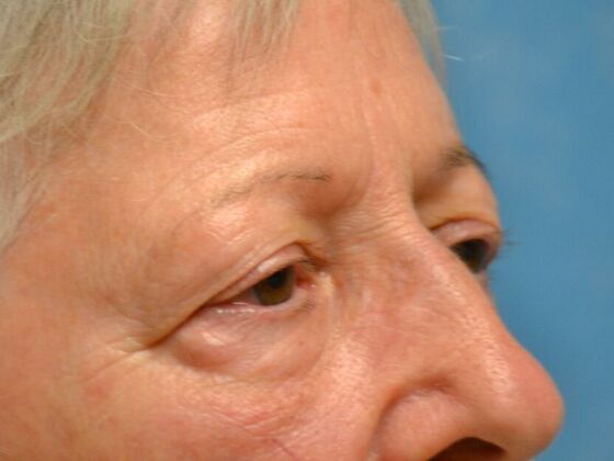 Eye Lift (Blepharoplasty): Case 1773- Temperance, MI - Before