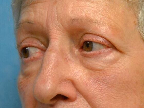 Eye Lift (Blepharoplasty): Case 1773- Temperance, MI - After