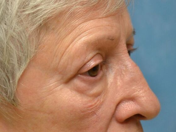 Eye Lift (Blepharoplasty): Case 1773- Temperance, MI - After