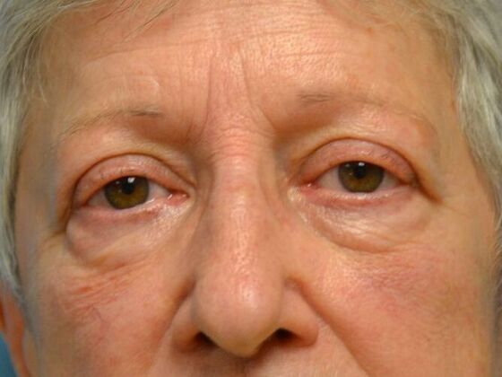 Eye Lift (Blepharoplasty) Case 1773- Temperance, MI - After
