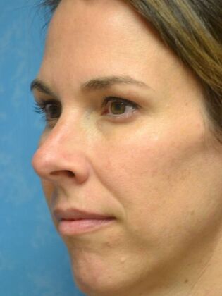 Rhinoplasty: Case 1724- Maumee, OH - Before