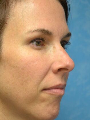 Rhinoplasty: Case 1724- Maumee, OH - Before