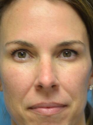 Rhinoplasty: Case 1724- Maumee, OH - Before