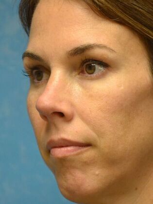 Rhinoplasty: Case 1724- Maumee, OH - After