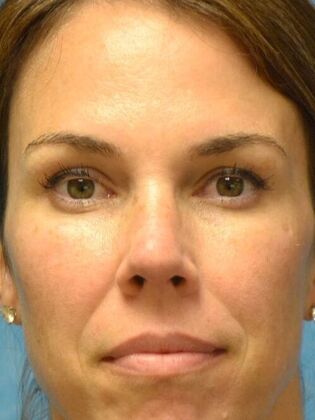 Rhinoplasty: Case 1724- Maumee, OH - After