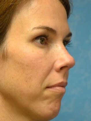 Rhinoplasty: Case 1724- Maumee, OH - After