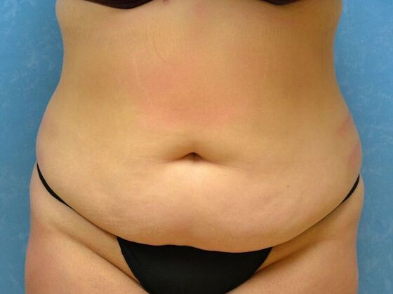 Tummy Tuck: Case 1798- Toledo, OH - Before