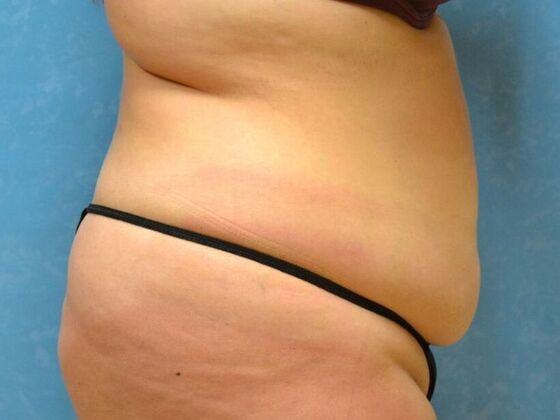 Tummy Tuck: Case 1798- Toledo, OH - Before
