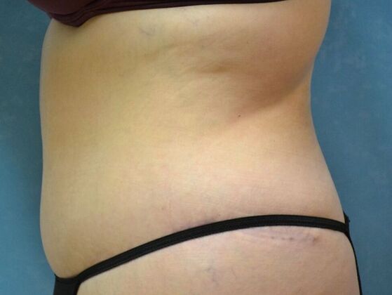 Tummy Tuck: Case 1798- Toledo, OH - After