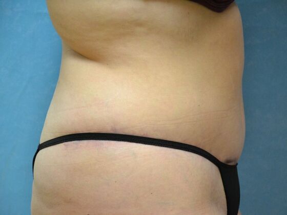 Tummy Tuck: Case 1798- Toledo, OH - After