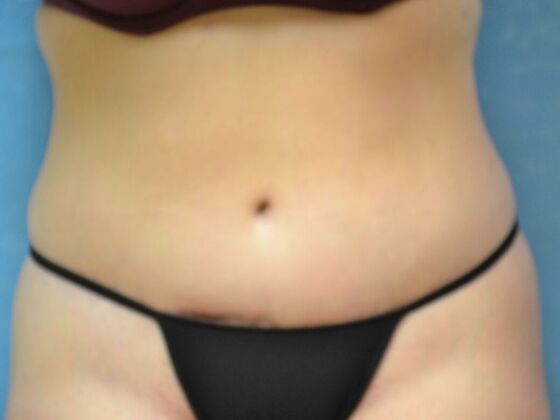 Tummy Tuck: Case 1798- Toledo, OH - After