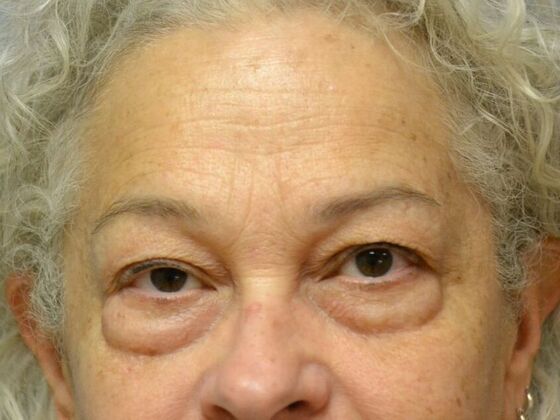 Eye Lift (Blepharoplasty) Case 1771- Toledo, OH - Before