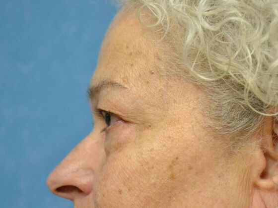 Eye Lift (Blepharoplasty): Case 1771- Toledo, OH - Before