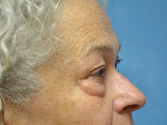 Eye Lift (Blepharoplasty): Case 1771- Toledo, OH - Before