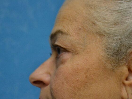 Eye Lift (Blepharoplasty): Case 1771- Toledo, OH - After