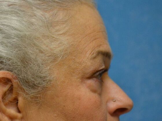 Eye Lift (Blepharoplasty): Case 1771- Toledo, OH - After