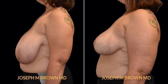 Breast Reduction: Case 1 - Before