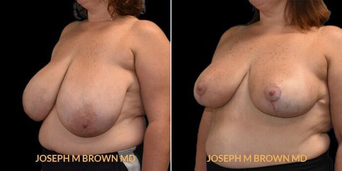 Breast Reduction: Case 1 - Before