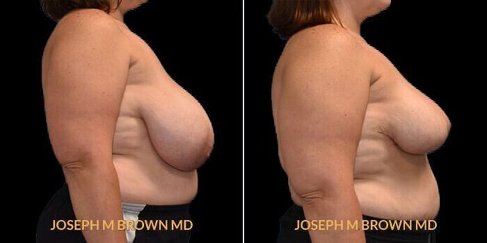 Breast Reduction: Case 1 - Before