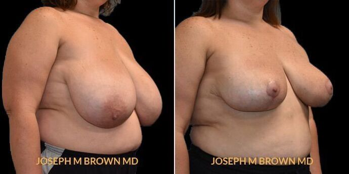 Breast Reduction: Case 1 - Before