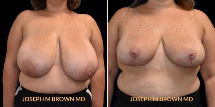 Breast Reduction Case 1