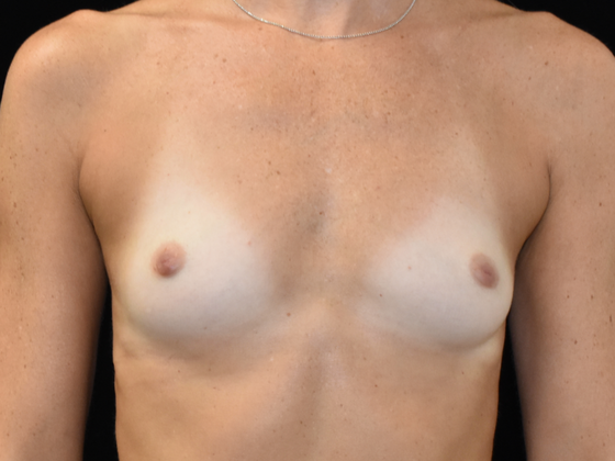 Breast Augmentation Case 6 - Before