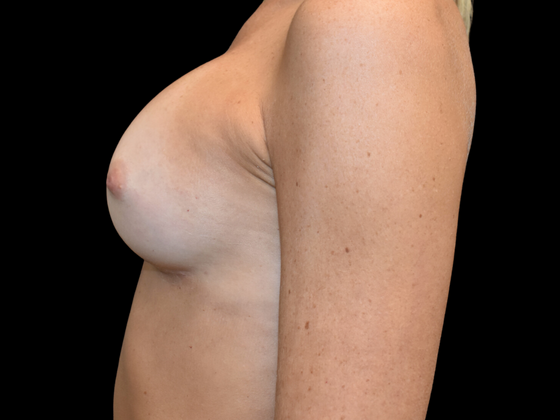 Breast Augmentation: Case 6 - After
