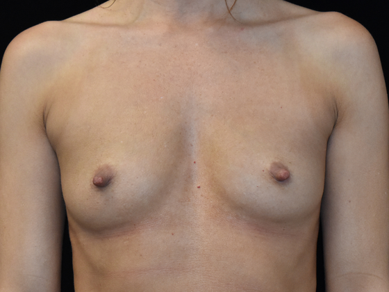 Breast Augmentation Case 7 - Before