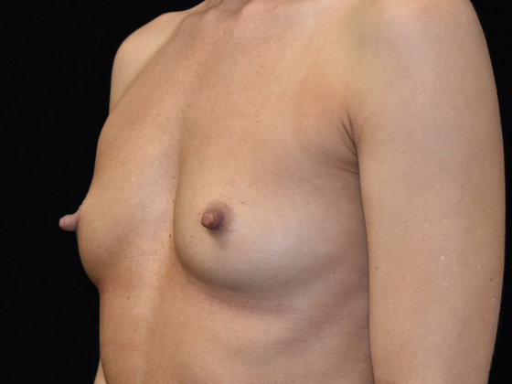 Breast Augmentation: Case 7 - Before
