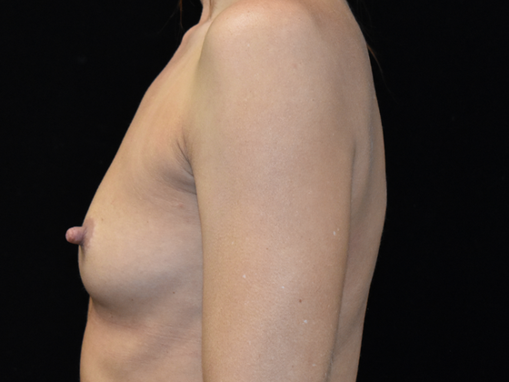 Breast Augmentation: Case 7 - Before