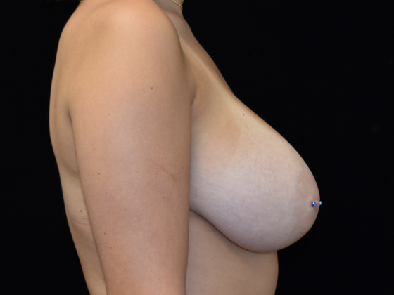 Breast Reduction: Case 3 - Before