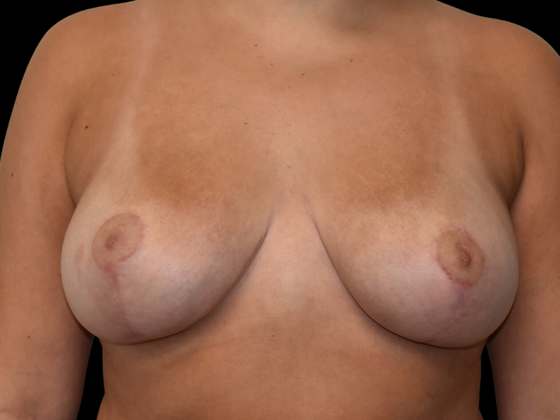 Breast Reduction Case 4 - After