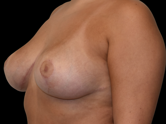 Breast Reduction: Case 4 - After