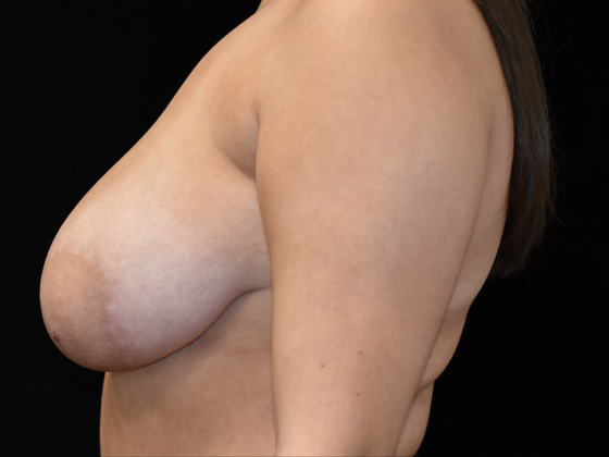 Breast Reduction: Case 4 - Before
