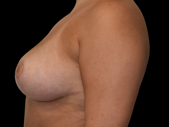 Breast Reduction: Case 4 - After